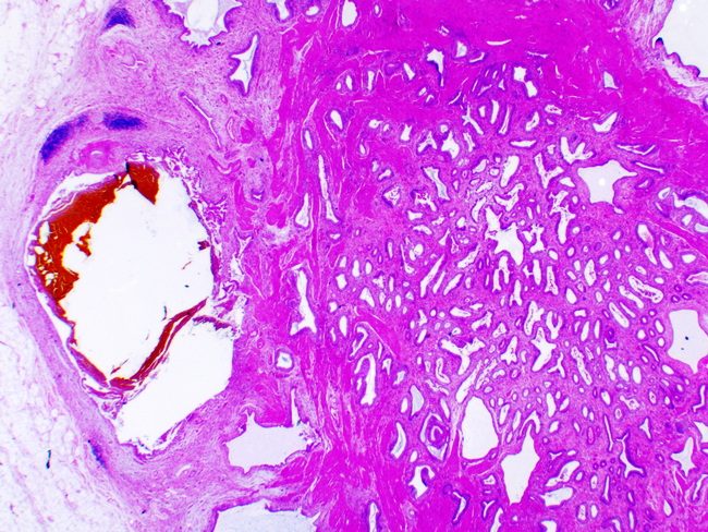 Gall bladder Adenomyoma_IZ.jpg